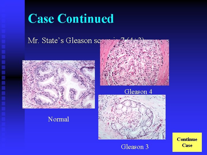 Case Continued Mr. State’s Gleason score is 7 (4+3). Gleason 4 Normal Gleason 3