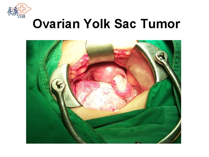 Ovarian Yolk Sac Tumor 