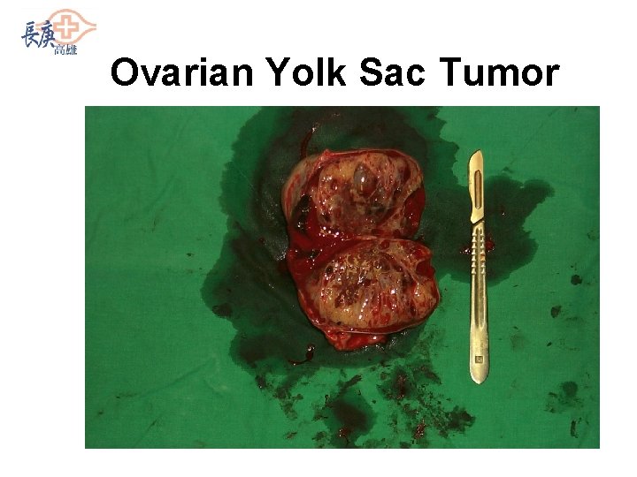 Ovarian Yolk Sac Tumor 
