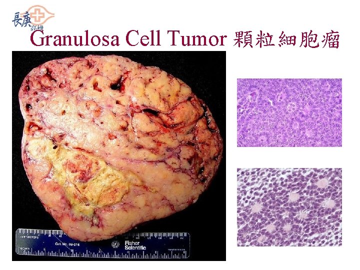 Granulosa Cell Tumor 顆粒細胞瘤 