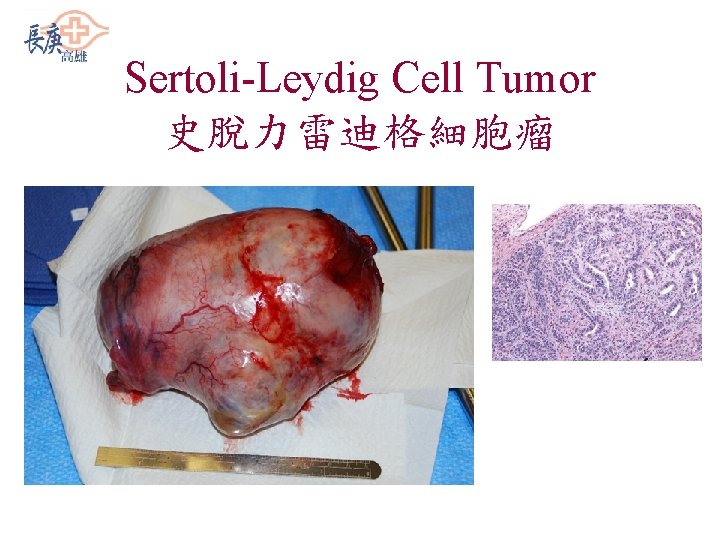 Sertoli-Leydig Cell Tumor 史脫力雷迪格細胞瘤 