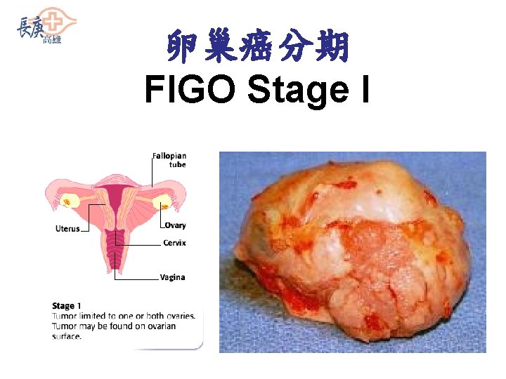 卵巢癌分期 FIGO Stage I 