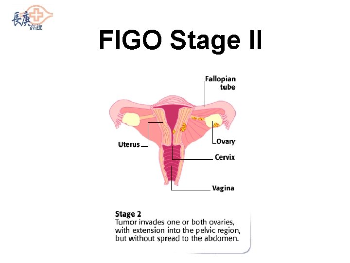 FIGO Stage II 