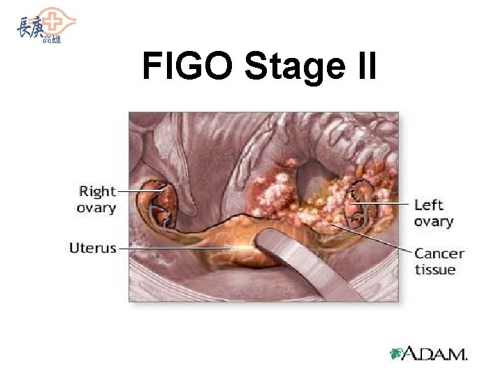 FIGO Stage II 