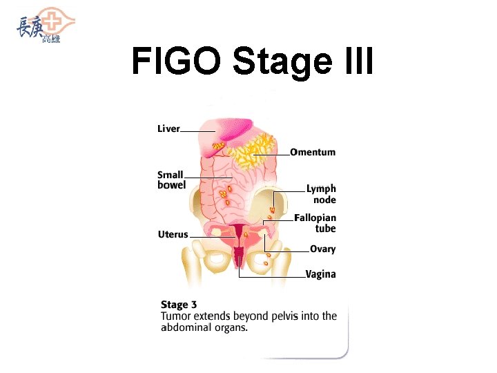 FIGO Stage III 