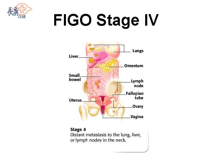FIGO Stage IV 