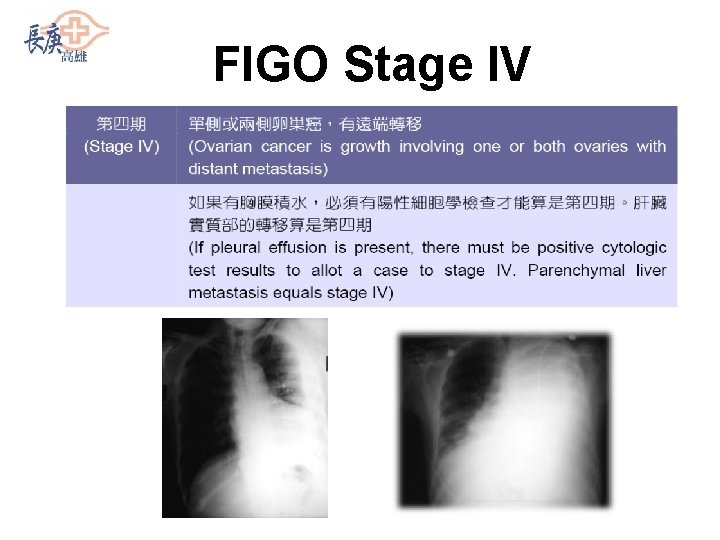 FIGO Stage IV 