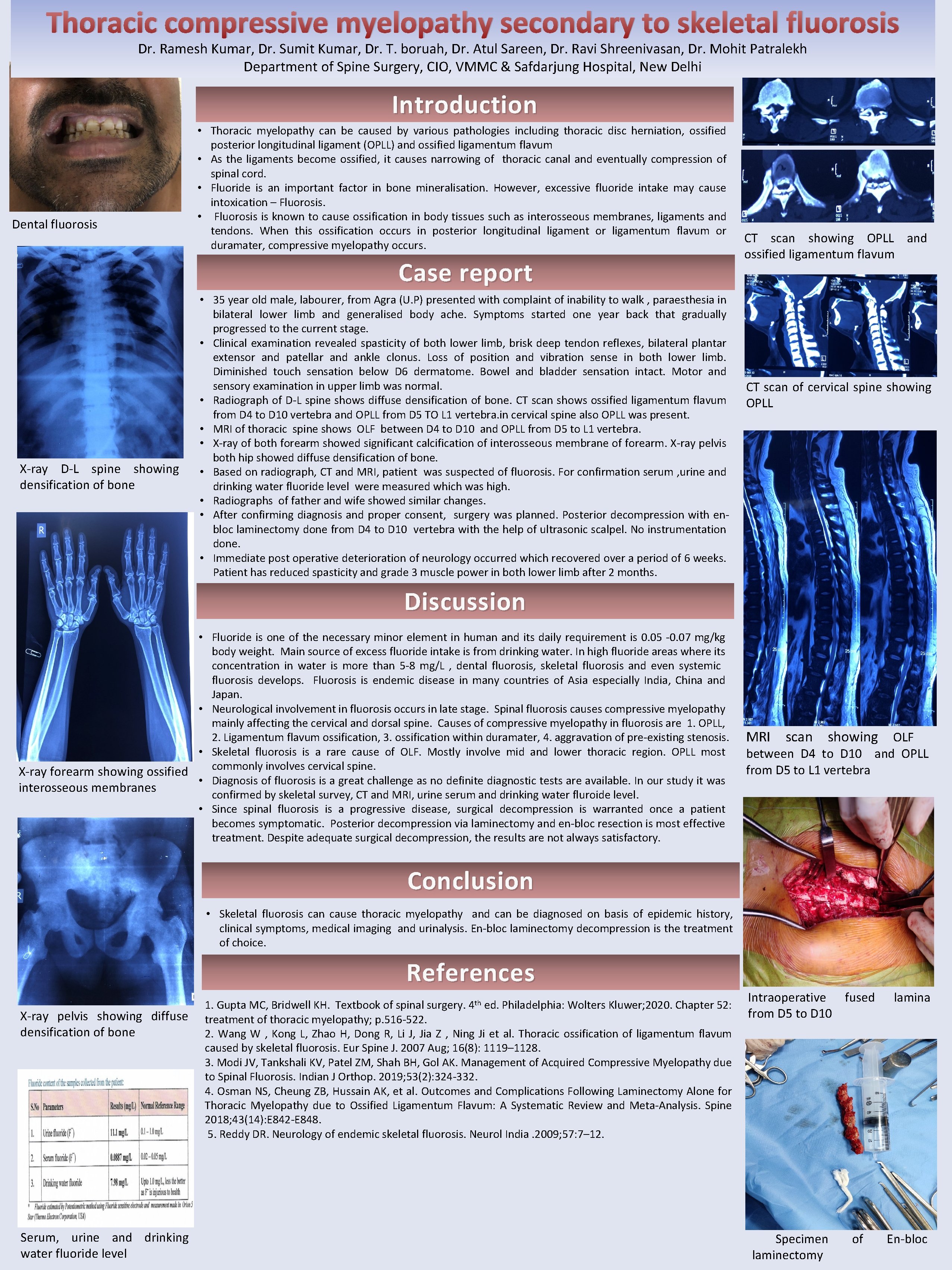 Thoracic compressive myelopathy secondary to skeletal fluorosis Dr. Ramesh Kumar, Dr. Sumit Kumar, Dr. Thoracic compressive myelopathy secondary to skeletal fluorosis Dr. Ramesh Kumar, Dr. Sumit Kumar, Dr.