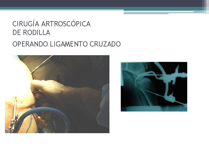 CIRUGÍA ARTROSCÓPICA DE RODILLA OPERANDO LIGAMENTO CRUZADO CIRUGÍA ARTROSCÓPICA DE RODILLA OPERANDO LIGAMENTO CRUZADO