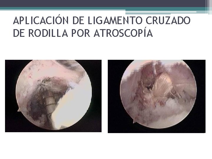 APLICACIÓN DE LIGAMENTO CRUZADO DE RODILLA POR ATROSCOPÍA APLICACIÓN DE LIGAMENTO CRUZADO DE RODILLA POR ATROSCOPÍA