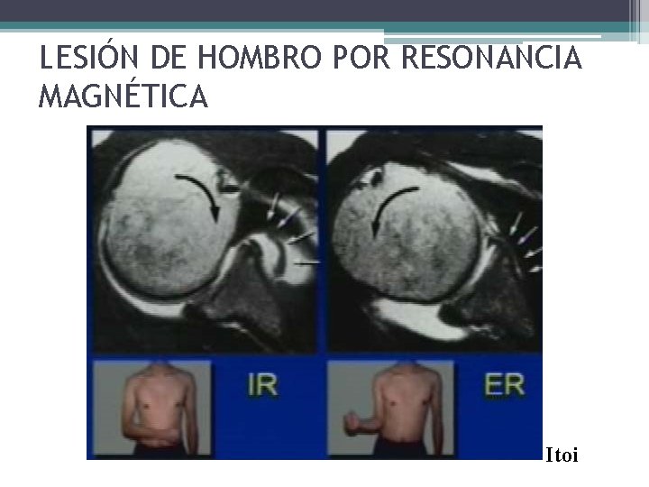 LESIÓN DE HOMBRO POR RESONANCIA MAGNÉTICA Itoi LESIÓN DE HOMBRO POR RESONANCIA MAGNÉTICA Itoi