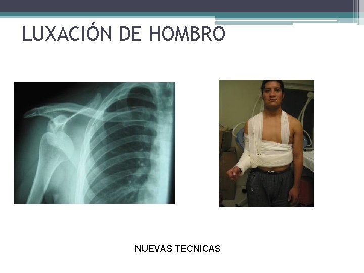 LUXACIÓN DE HOMBRO NUEVAS TECNICAS LUXACIÓN DE HOMBRO NUEVAS TECNICAS