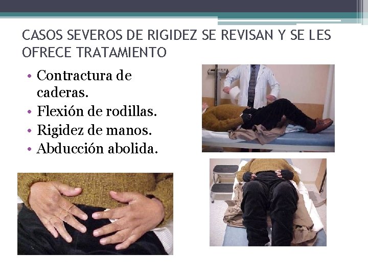 CASOS SEVEROS DE RIGIDEZ SE REVISAN Y SE LES OFRECE TRATAMIENTO • Contractura de CASOS SEVEROS DE RIGIDEZ SE REVISAN Y SE LES OFRECE TRATAMIENTO • Contractura de