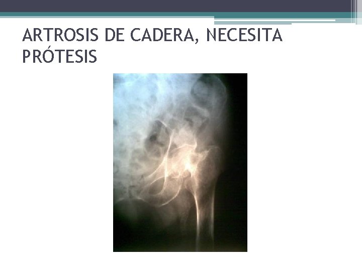 ARTROSIS DE CADERA, NECESITA PRÓTESIS ARTROSIS DE CADERA, NECESITA PRÓTESIS