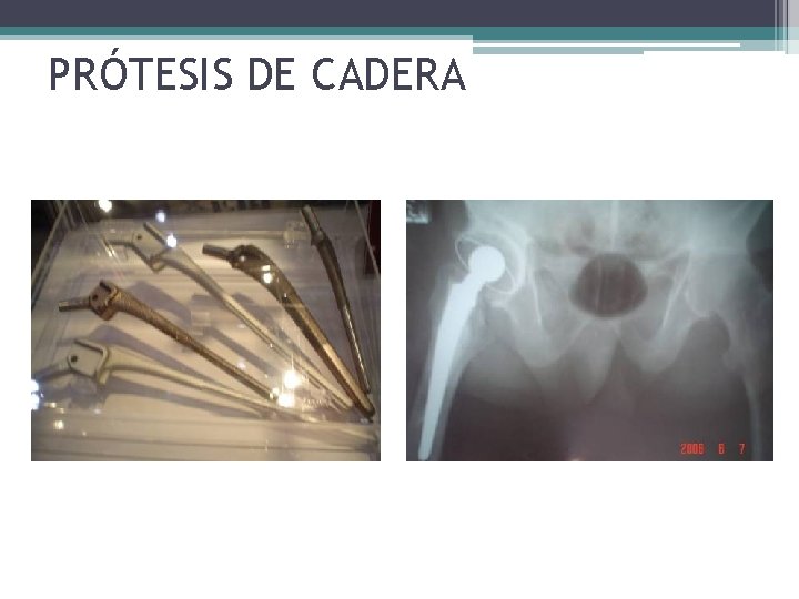 PRÓTESIS DE CADERA PRÓTESIS DE CADERA