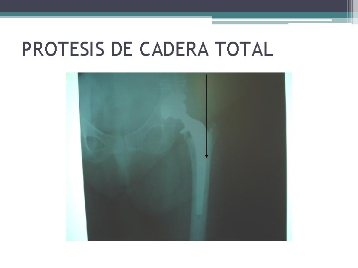 PROTESIS DE CADERA TOTAL PROTESIS DE CADERA TOTAL