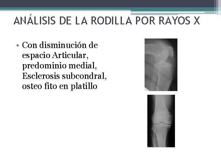 ANÁLISIS DE LA RODILLA POR RAYOS X • Con disminución de espacio Articular, predominio ANÁLISIS DE LA RODILLA POR RAYOS X • Con disminución de espacio Articular, predominio