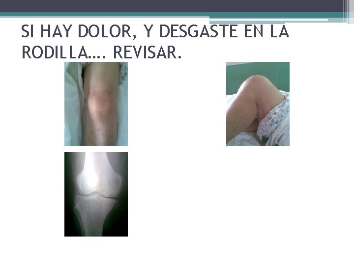 SI HAY DOLOR, Y DESGASTE EN LA RODILLA…. REVISAR. SI HAY DOLOR, Y DESGASTE EN LA RODILLA…. REVISAR.