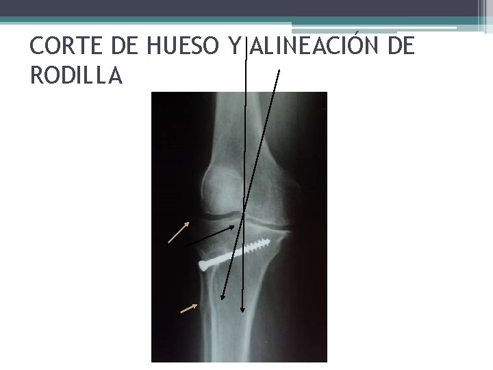 CORTE DE HUESO Y ALINEACIÓN DE RODILLA CORTE DE HUESO Y ALINEACIÓN DE RODILLA