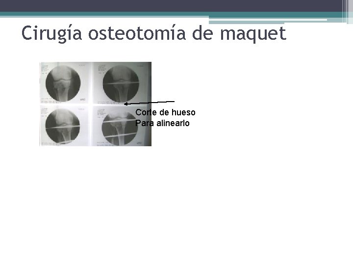 Cirugía osteotomía de maquet Corte de hueso Para alinearlo Cirugía osteotomía de maquet Corte de hueso Para alinearlo