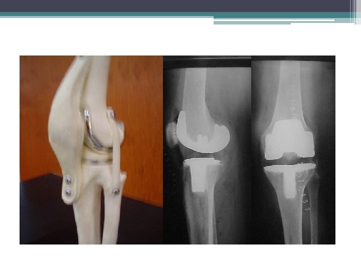 PROTESIS DE RODILLA PROTESIS DE RODILLA