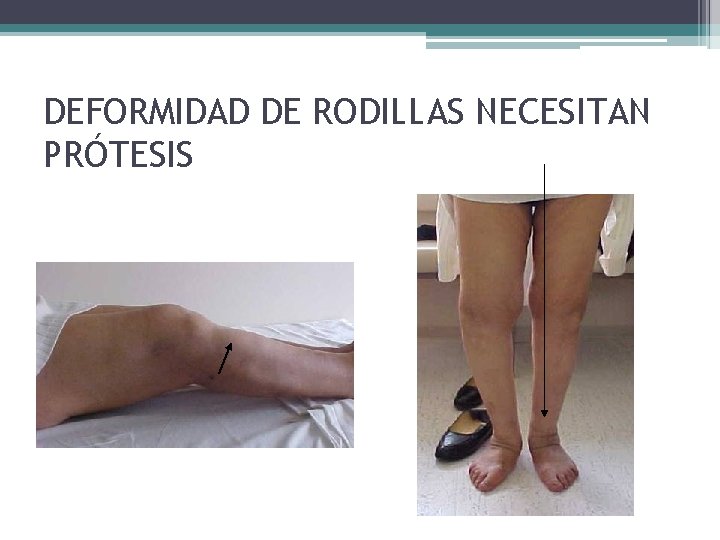 DEFORMIDAD DE RODILLAS NECESITAN PRÓTESIS DEFORMIDAD DE RODILLAS NECESITAN PRÓTESIS