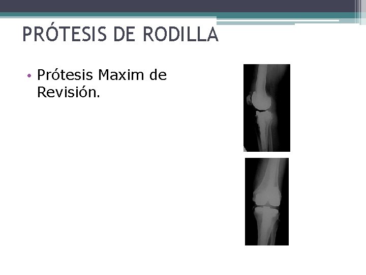 PRÓTESIS DE RODILLA • Prótesis Maxim de Revisión. PRÓTESIS DE RODILLA • Prótesis Maxim de Revisión.