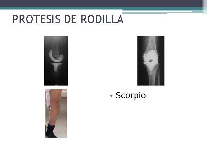 PROTESIS DE RODILLA • Scorpio PROTESIS DE RODILLA • Scorpio