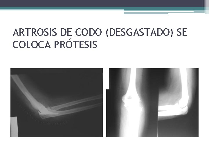 ARTROSIS DE CODO (DESGASTADO) SE COLOCA PRÓTESIS ARTROSIS DE CODO (DESGASTADO) SE COLOCA PRÓTESIS