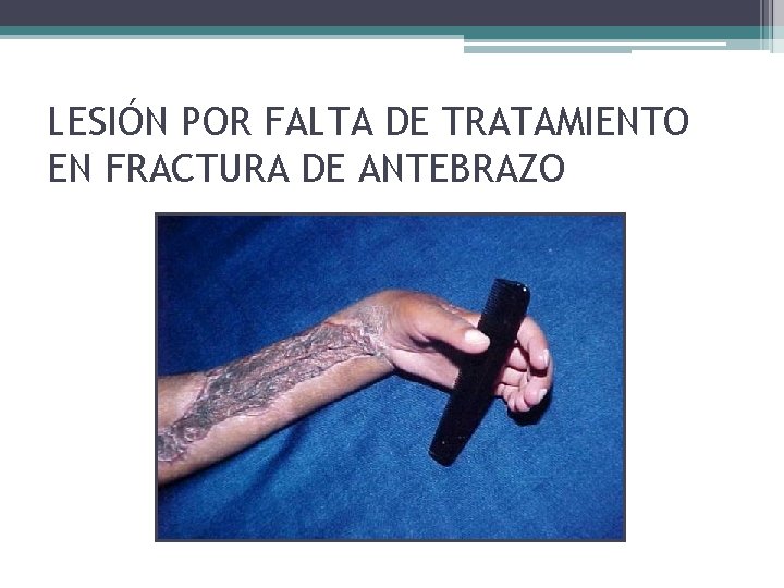 LESIÓN POR FALTA DE TRATAMIENTO EN FRACTURA DE ANTEBRAZO LESIÓN POR FALTA DE TRATAMIENTO EN FRACTURA DE ANTEBRAZO