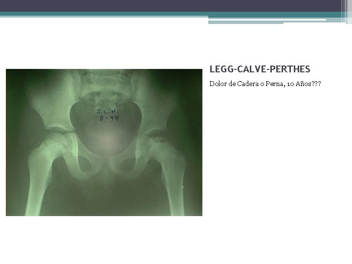 LEGG-CALVE-PERTHES Dolor de Cadera o Perna, 10 Años? ? ? LEGG-CALVE-PERTHES Dolor de Cadera o Perna, 10 Años? ? ?