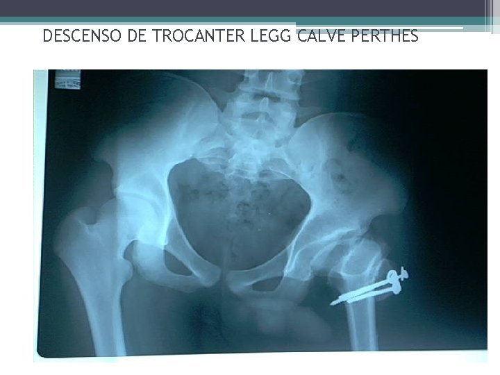 DESCENSO DE TROCANTER LEGG CALVE PERTHES DESCENSO DE TROCANTER LEGG CALVE PERTHES