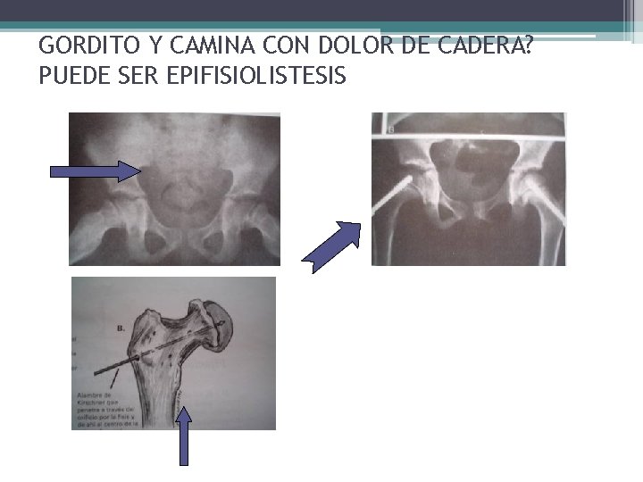 GORDITO Y CAMINA CON DOLOR DE CADERA? PUEDE SER EPIFISIOLISTESIS GORDITO Y CAMINA CON DOLOR DE CADERA? PUEDE SER EPIFISIOLISTESIS