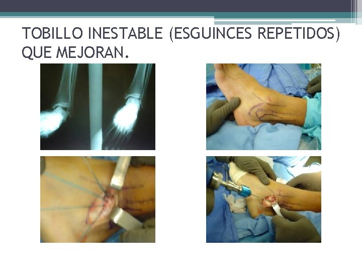 TOBILLO INESTABLE (ESGUINCES REPETIDOS) QUE MEJORAN. TOBILLO INESTABLE (ESGUINCES REPETIDOS) QUE MEJORAN.