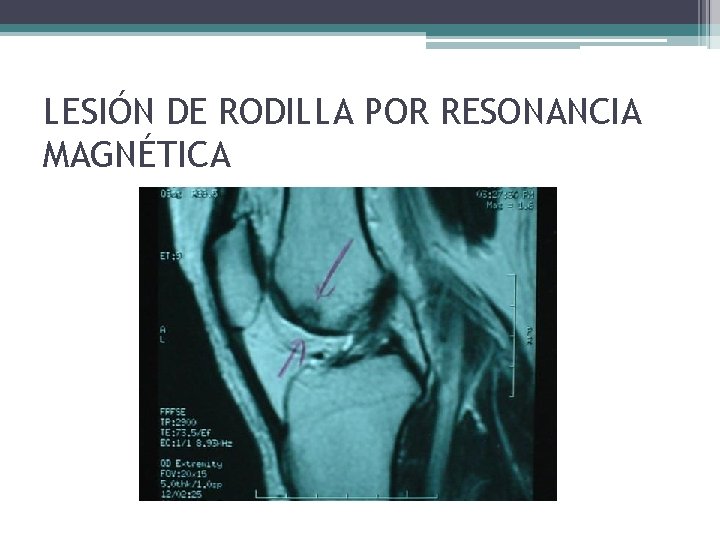 LESIÓN DE RODILLA POR RESONANCIA MAGNÉTICA LESIÓN DE RODILLA POR RESONANCIA MAGNÉTICA