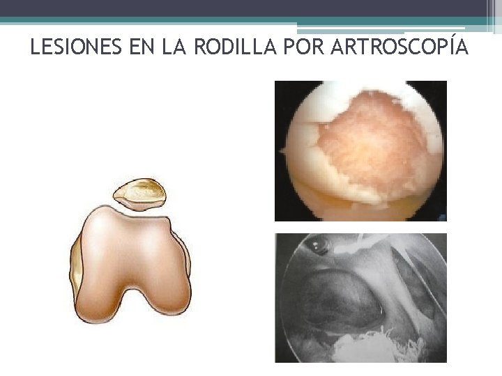 LESIONES EN LA RODILLA POR ARTROSCOPÍA LESIONES EN LA RODILLA POR ARTROSCOPÍA