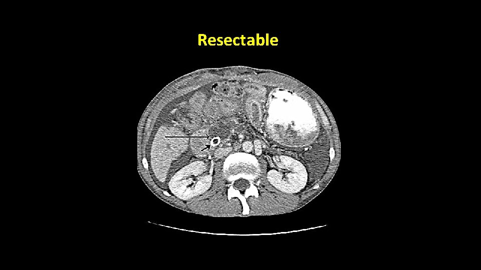 Resectable Resectable
