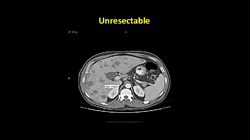 Unresectable Unresectable