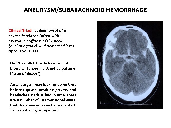 ANEURYSM/SUBARACHNOID HEMORRHAGE Clinical Triad: sudden onset of a severe headache (often with exertion), stiffness