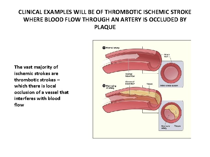 CLINICAL EXAMPLES WILL BE OF THROMBOTIC ISCHEMIC STROKE WHERE BLOOD FLOW THROUGH AN ARTERY