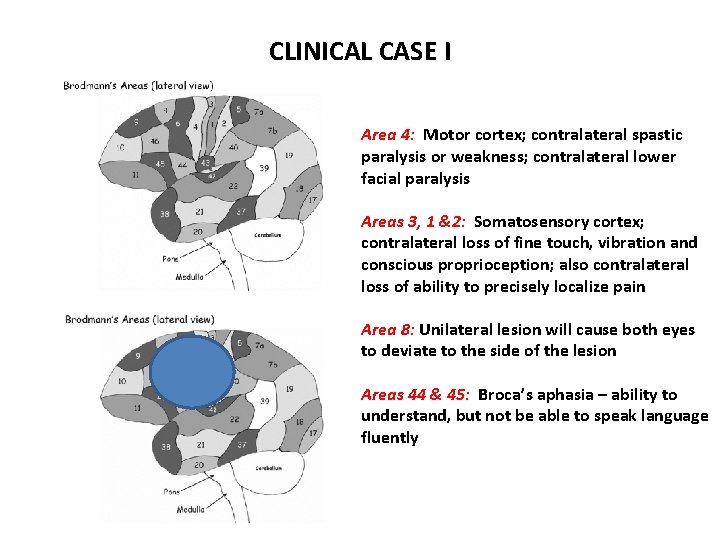 CLINICAL CASE I Area 4: Motor cortex; contralateral spastic paralysis or weakness; contralateral lower