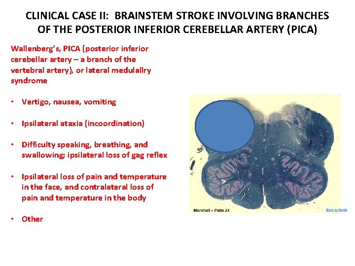 CLINICAL CASE II: BRAINSTEM STROKE INVOLVING BRANCHES OF THE POSTERIOR INFERIOR CEREBELLAR ARTERY (PICA)