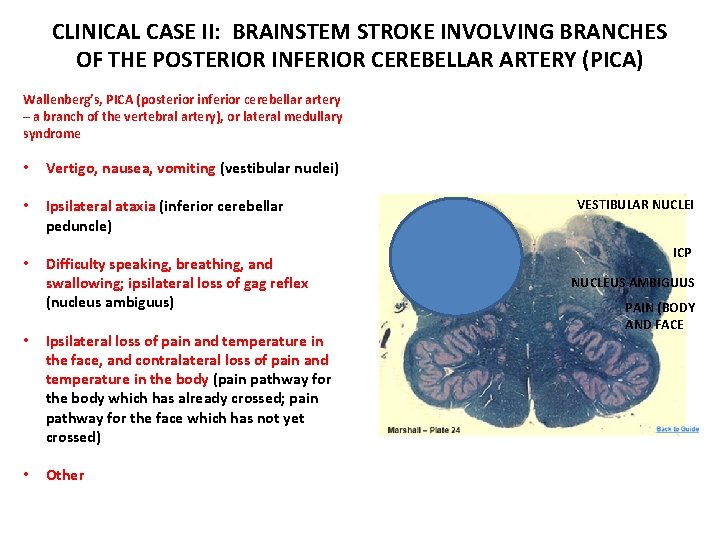 CLINICAL CASE II: BRAINSTEM STROKE INVOLVING BRANCHES OF THE POSTERIOR INFERIOR CEREBELLAR ARTERY (PICA)