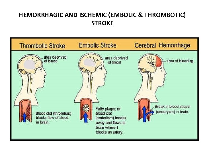 HEMORRHAGIC AND ISCHEMIC (EMBOLIC & THROMBOTIC) STROKE 
