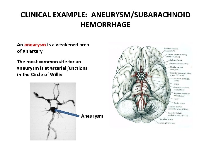 CLINICAL EXAMPLE: ANEURYSM/SUBARACHNOID HEMORRHAGE An aneurysm is a weakened area of an artery The