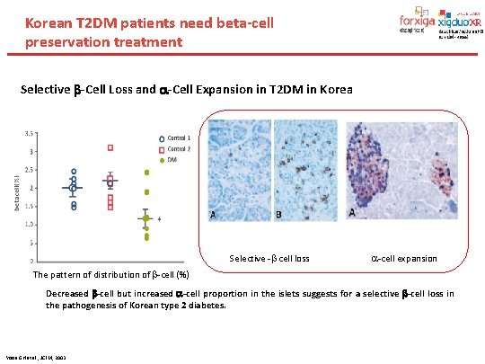 Korean T 2 DM patients need beta-cell preservation treatment Selective -Cell Loss and -Cell