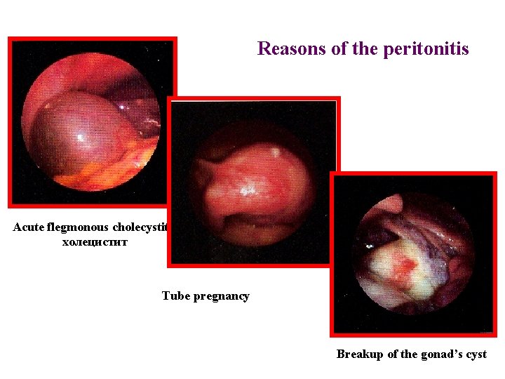 Reasons of the peritonitis Acute flegmonous cholecystitis холецистит Tube pregnancy Breakup of the gonad’s Reasons of the peritonitis Acute flegmonous cholecystitis холецистит Tube pregnancy Breakup of the gonad’s