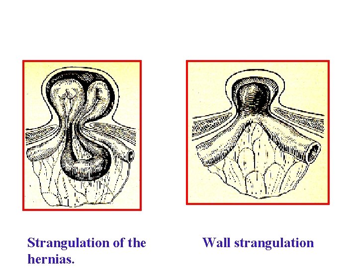 Strangulation of the hernias. Wall strangulation Strangulation of the hernias. Wall strangulation