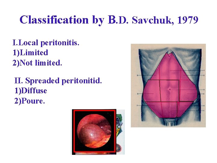 Classification by B. D. Savchuk, 1979 I. Local peritonitis. 1)Limited 2)Not limited. II. Spreaded Classification by B. D. Savchuk, 1979 I. Local peritonitis. 1)Limited 2)Not limited. II. Spreaded