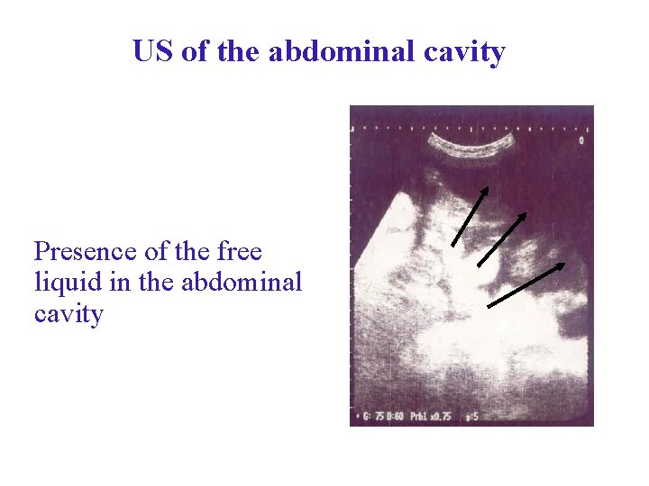 US of the abdominal cavity Presence of the free liquid in the abdominal cavity US of the abdominal cavity Presence of the free liquid in the abdominal cavity